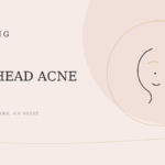 How to Get Rid of Forehead Acne: A 2026 Guide (Huntington Park)